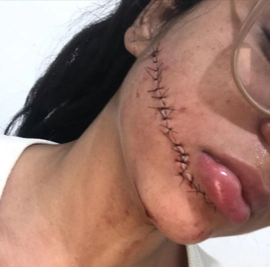 Estudante tem rosto cortado enquanto dormia em viagem de ônibus: "O ataque foi gratuito"