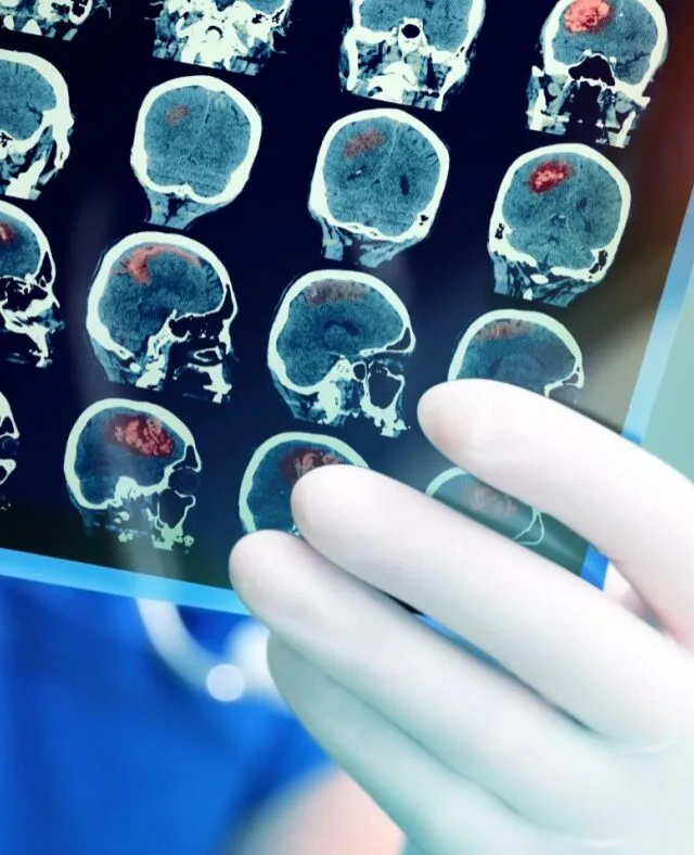Takeda fecha acordo de US$ 2,2 bilhões com startup para desenvolver vacina contra o Alzheimer