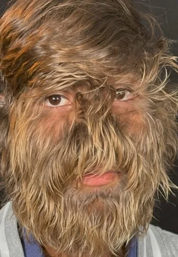 Adolescente indiano entra para o 'Guinness' por quebrar recorde de rosto mais peludo